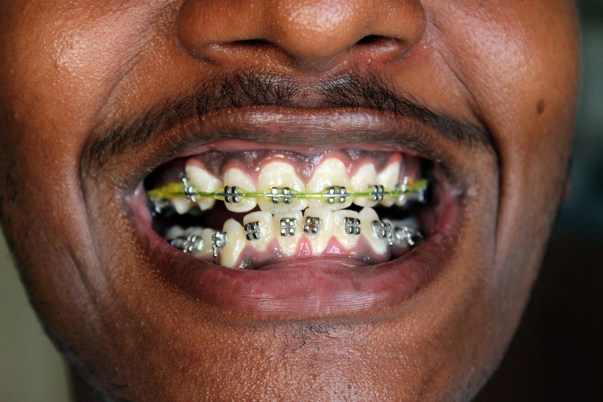 Braces And Orthodontics Schubbs Dental