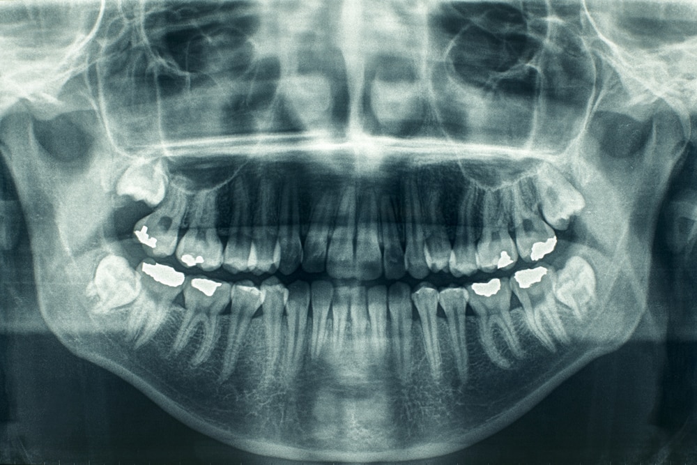 ORAL X-RAYS | Schubbs Dental