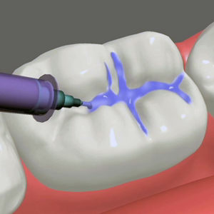Image shows the procedure of pit and fissure sealants therapy on a tooth