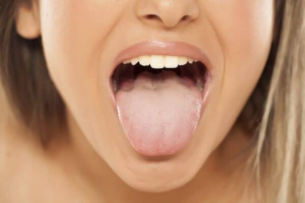 Burning mouth syndrome : Image showing a woman's tongue with possible burning mouth syndrome