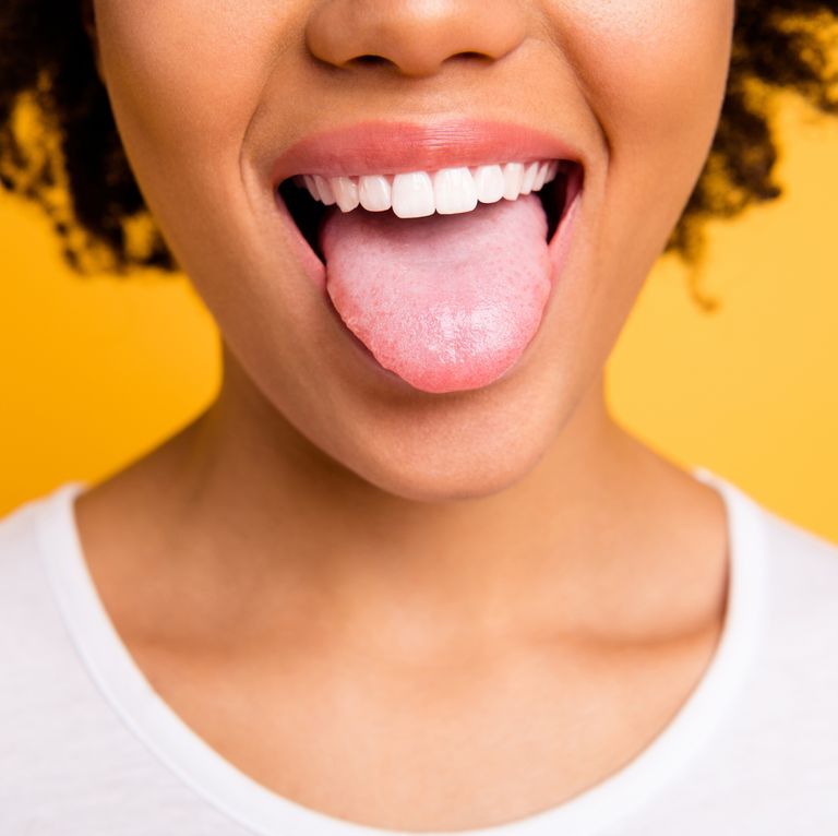 Geographic tongue - Image showing a woman's tongue
