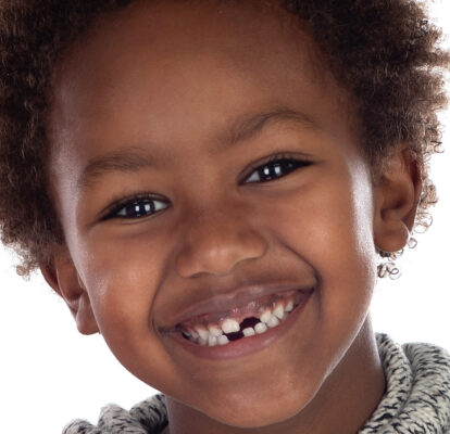 DENTAL INJURIES IN CHILDREN : Image showing missing teeth in a happy African child
