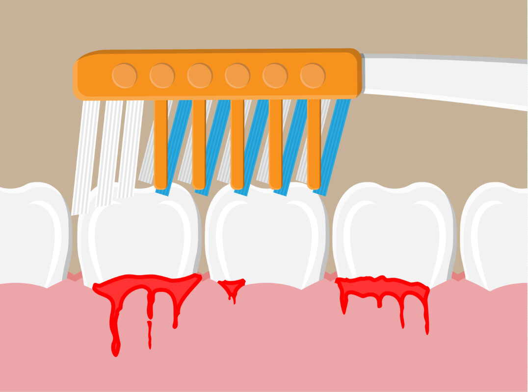 BLEEDING GUMS - An illustration of a toothbrush on bleeding gums