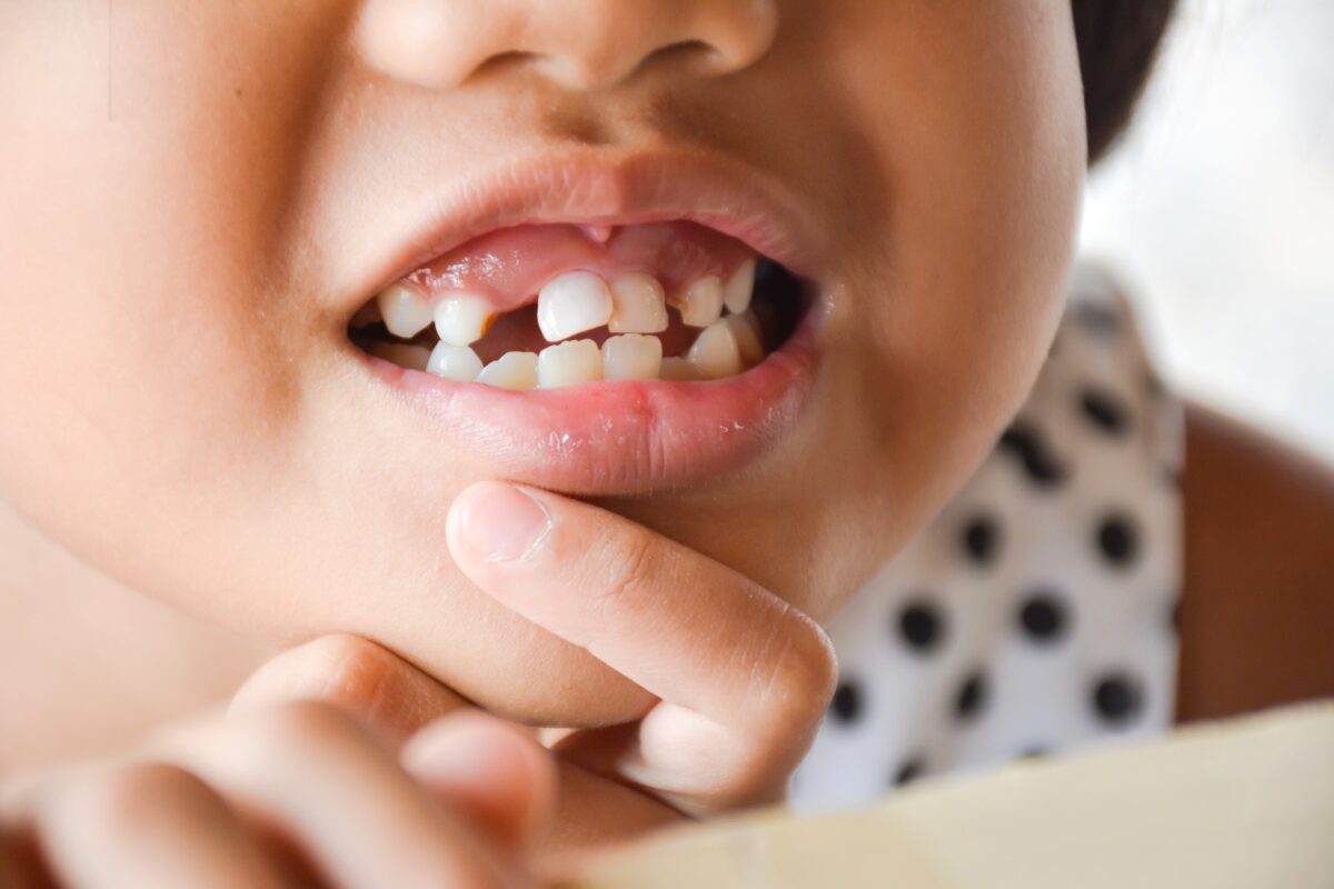 DENTAL INJURIES IN CHILDREN : Image showing broken teeth in a child