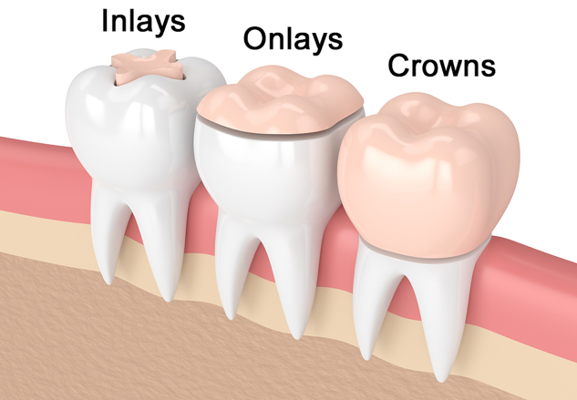 Dental inlays and onlays : Image illustrating dental inlays, dental onlays and dental crowns